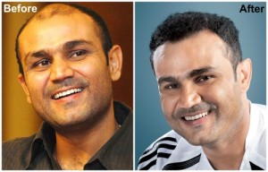 Sehwag hair transplant