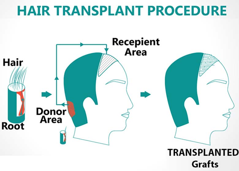 Finest Hair Transplant Surgeries That Are Now Available In India