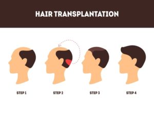 hair transplant surgery process