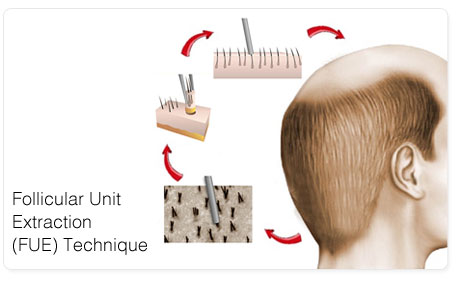 FUE hair transplant