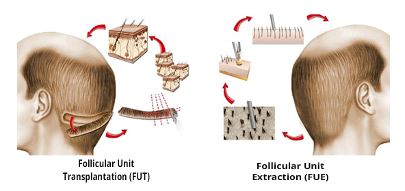 fue hair transplant