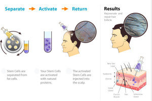 stem cell therapy for hair loss