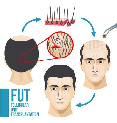 Best Hair Transplant in Delhi - FUE Hair Transplant Cost | NHT India