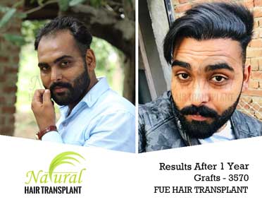 FUE Hair Transplant in Rourkela | Best Doctors, Clinics & Cost