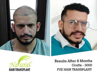 FUE Hair Transplant in Nagaland, Kohima