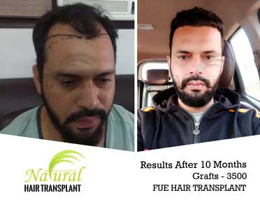 Best Hair Transplant Jalandhar | Hair Transplant Cost In Jalandhar | NHT