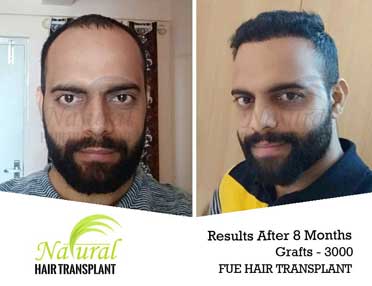 FUE Hair Transplant in Nagaland, Kohima