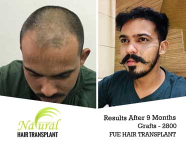 Best Hair Transplant Surgery Clinic in Kanpur with effective cost
