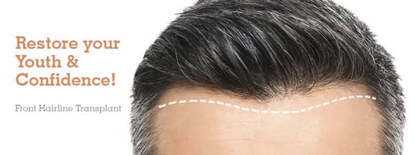 Hair Transplant in Bangalore - FUE Hair Transplant Cost | NHT India